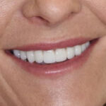 After Cosmetic Dentistry