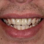 After Cosmetic Dentistry