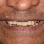 After Cosmetic Dentistry