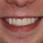 After Cosmetic Dentistry