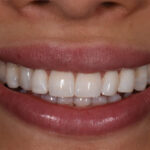 After Cosmetic Dentistry