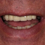 After Cosmetic Dentistry