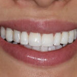 After Cosmetic Dentistry