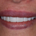 After Cosmetic Dentistry