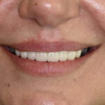 After Cosmetic Dentistry