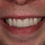 After Cosmetic Dentistry