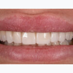 After Cosmetic Dentistry