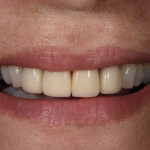 After Cosmetic Dentistry