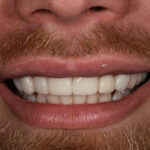 After Cosmetic Dentistry