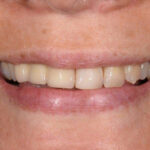 After Cosmetic Dentistry