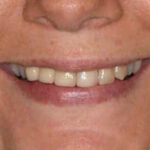 After Cosmetic Dentistry