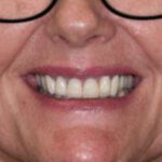 After Cosmetic Dentistry