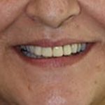 After Cosmetic Dentistry Carol