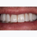 After Cosmetic Dentistry