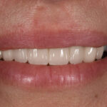 After Cosmetic Dentistry