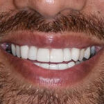 After Cosmetic Dentistry