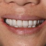 After Cosmetic Dentistry - Crowns & Bridges