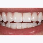 After Porcelain Veneers