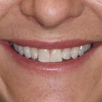 Before Cosmetic Dentistry