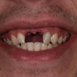 Before Cosmetic Dentistry