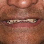 Before Cosmetic Dentistry