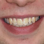 Before Cosmetic Dentistry