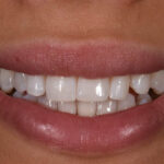 Before Cosmetic Dentistry