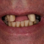 Before Cosmetic Dentistry