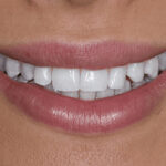 After Cosmetic Dentistry