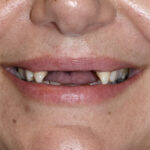 Before Cosmetic Dentistry