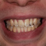 Before Cosmetic Dentistry