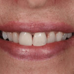 Before Cosmetic Dentistry