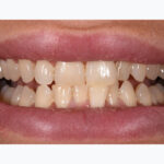 Before Cosmetic Dentistry