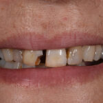 Before Cosmetic Dentistry