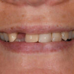 Before Cosmetic Dentistry