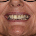 Before Cosmetic Dentistry