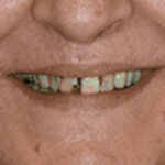 Before Cosmetic Dentistry Carol