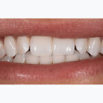 Before Cosmetic Dentistry