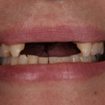 Before Cosmetic Dentistry