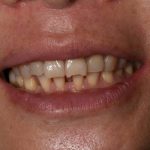 Before Cosmetic Dentistry - Crowns & Bridges