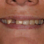 Before Cosmetic Dentistry