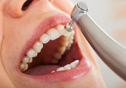 Do I Need To Get My Teeth Cleaned Professionally?