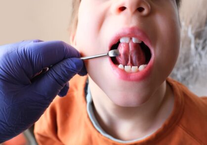 Is a Frenectomy Worth It? Here’s What You Need to Know