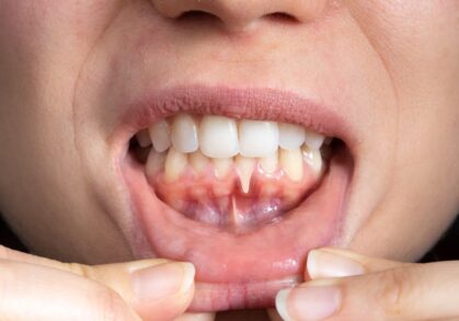 What Causes Receding Gums and How to Stop It