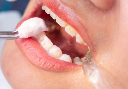 The Role of Fluoride in Preventing Cavities