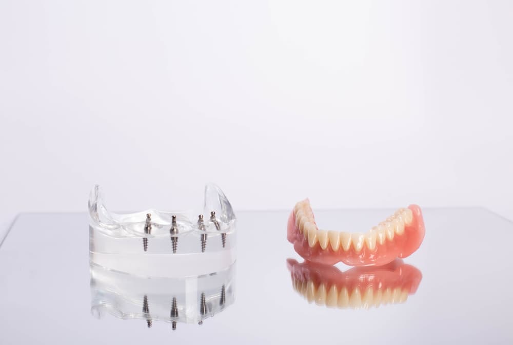 Implant-Supported Over-Dentures
