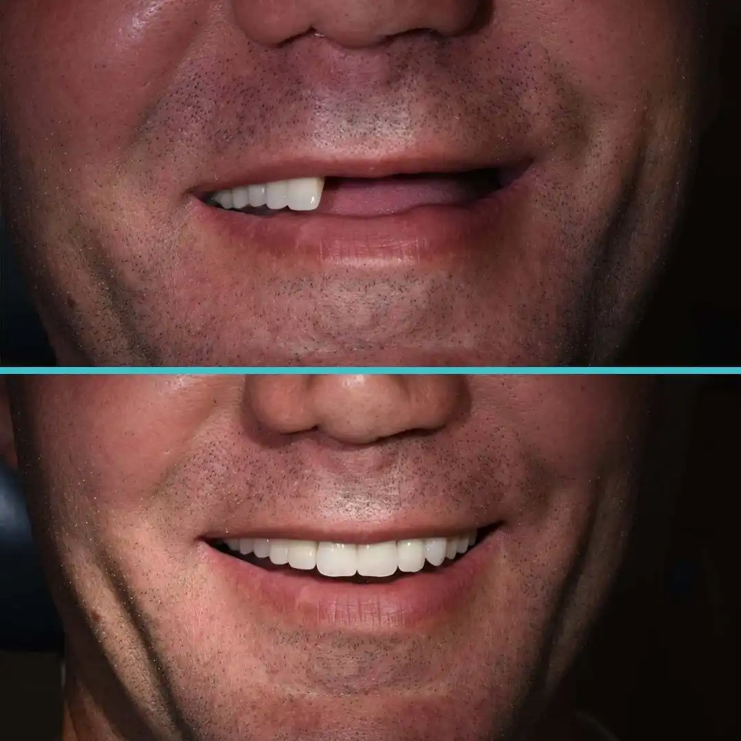 Acrylic Dentures Before After Case Result