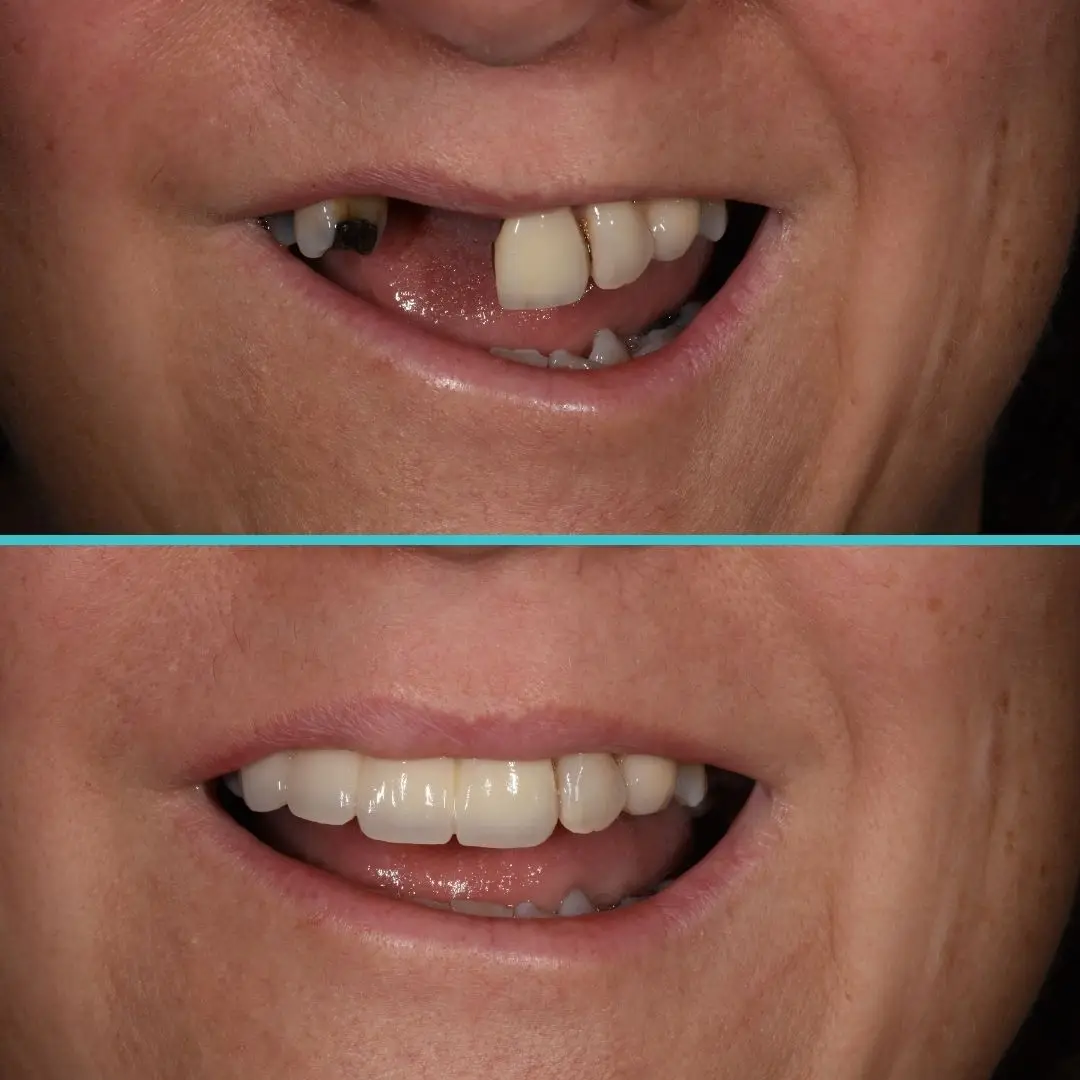 Crown-and-Bridge Before and After Result
