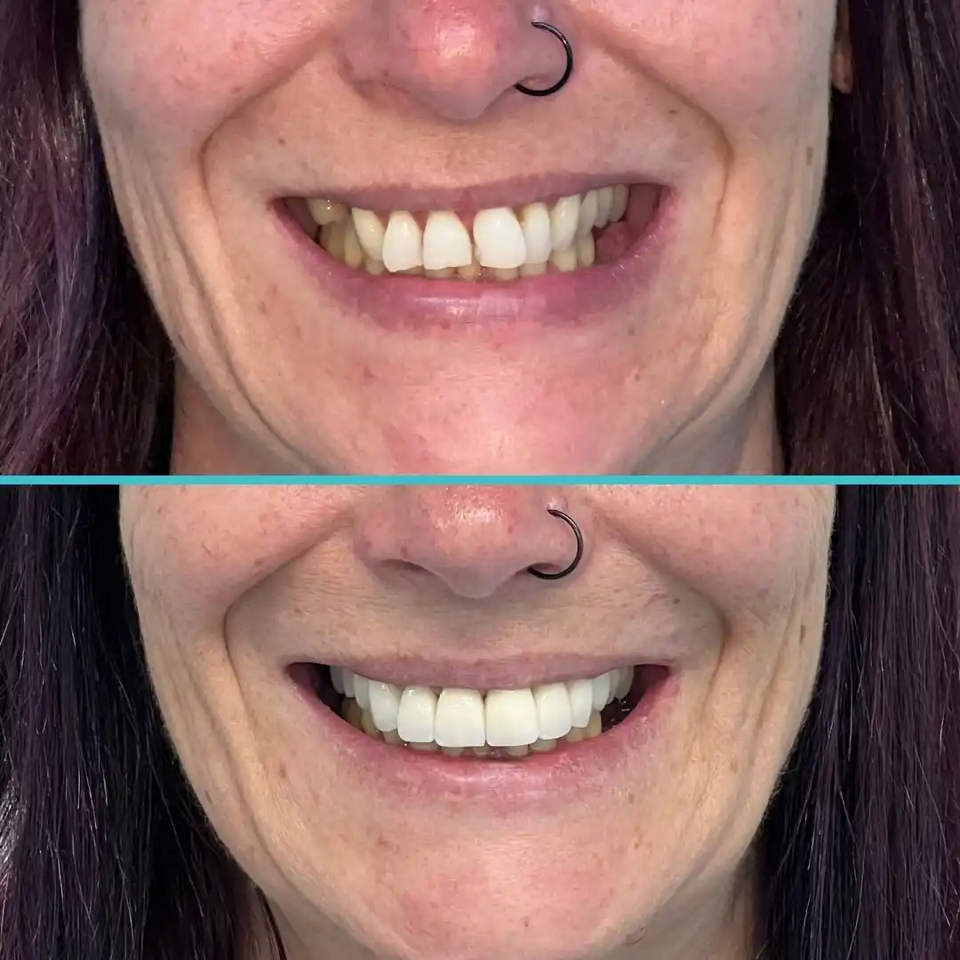 Crowns Before and After Result