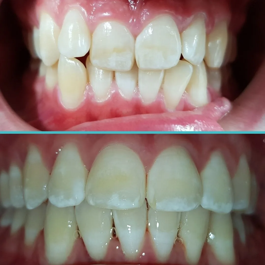 Orthodontics Teeth Straightening - Before and After Result